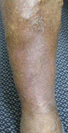 DH_30MAR09 Fully healed in 3 weeks
