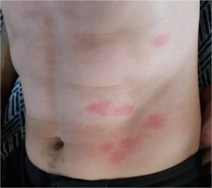 Jellyfish sting body before Wheatfix Burn Spray Fig.1. Abdominal stings from jellyfish tentacles. Wheatgrass extract applied.