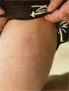 Jellyfish sting leg after Wheatfix burnspray Fig.2. 1 hour and 15 minutes later wound is pain-free and rash barely visible.