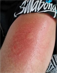 Jellyfish sting leg before wheatfix burn spray Fig.1. Bluebottle (jellyfish) sting from under the bell (head). Wheatgrass extract applied.