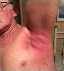 Radiation burn testimonial fig 11. Feb 11th 2016 wheatgrass extract quickly heals radiation burns and relieves pain