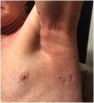 Radiation burn testimonial fig 15 Feb 17th 2016 from T. C 16 days. Inflammation and pain-free.