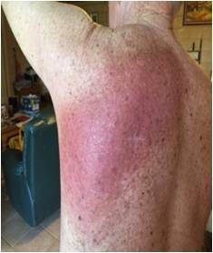 Radiation burn testimonial fig 2 from T. C Same day. Marked radiation burn over treated area. Note light coloured horizontal scar from initial melanoma excision one year ago.