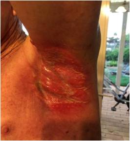 Radiation burn testimonial fig 4 Feb 01 2016 from T. C Same day, after shower. Wheatgrass extract applied and pain was relieved instantly.