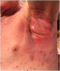 Radiation burn testimonial fig 8 Feb 03rd 2016 from T. C After 2 days' wheatgrass extract application. Swelling & inflammation markedly reduced. Wound healing well.