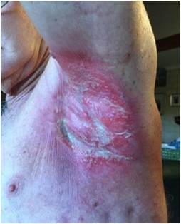 Radiation burn testimonial from T. C radiation burn pre-wheatgrass treatment
