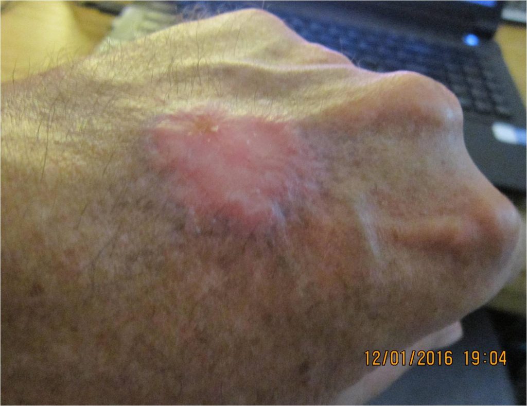 Spider bite 9 years old healed by wheatgrass healing of 9 year old spider bite with wheatgrass