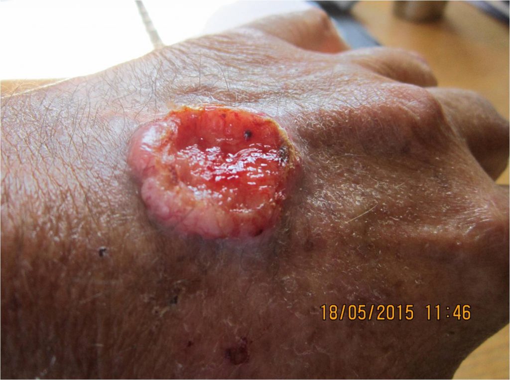 Spider bite 18 May 2015 Wound not healing for 9 years.Treatment with daily wheatgrass extract commenced.
