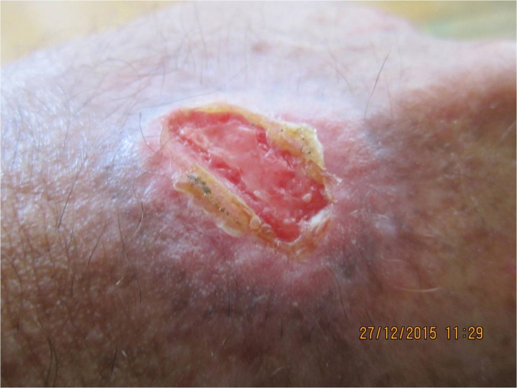 spider bite wound healing with wheatgrass