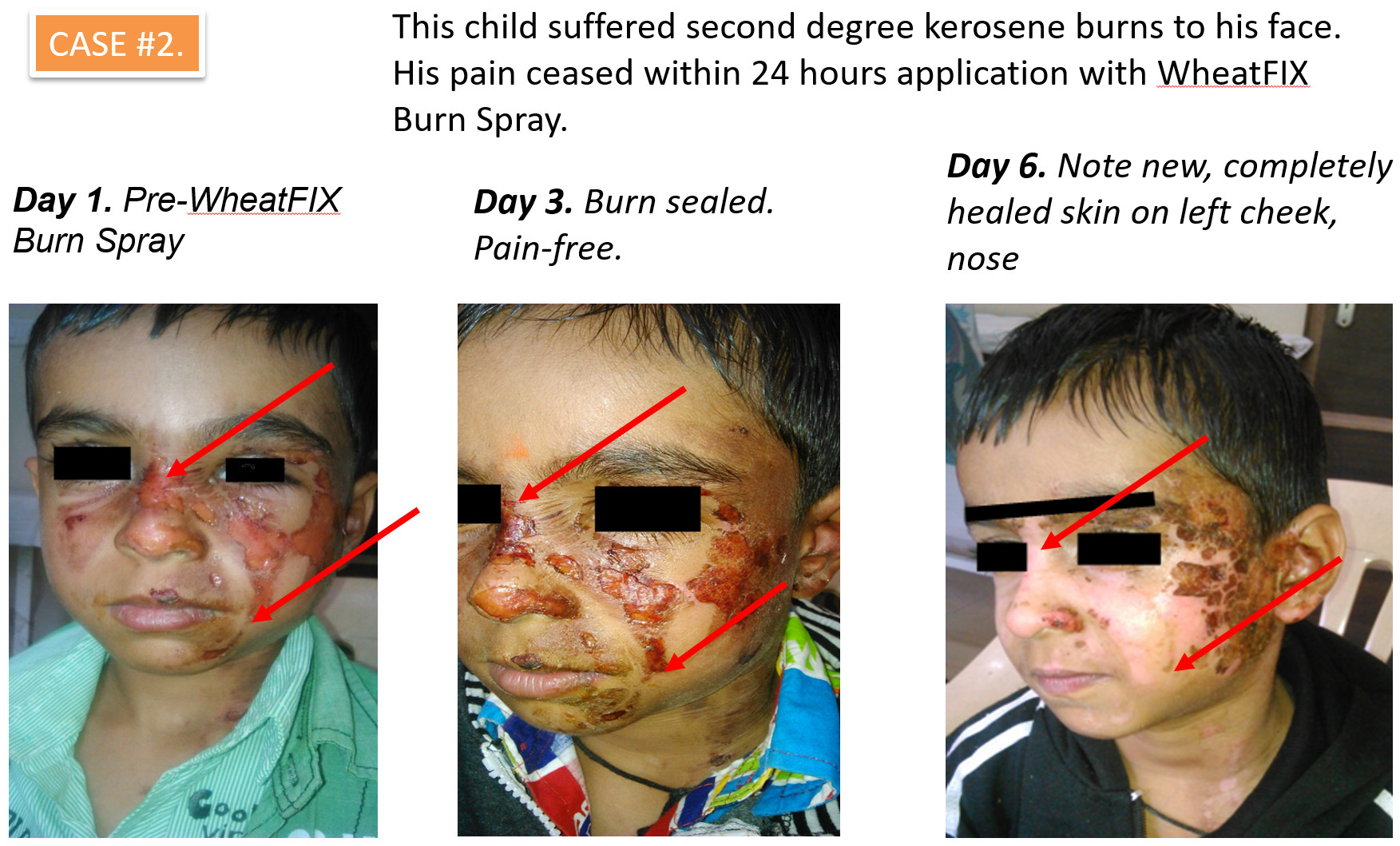 Wheatfix heals second degree burns in 6 days.