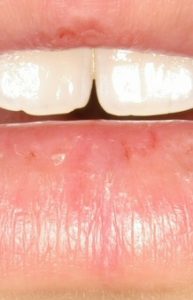 lower lip aft 20 August 04. Wound healed two weeks after one application of wheatgrass extract.