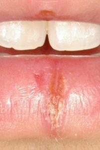 6 August 04. Split lower lip. Chronic wound - present approx. 12 months. Painful. Patient unable to laugh or smile. Numerous attempts at healing.