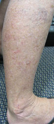 zoster_2_after shingles cured by wheatgrass
