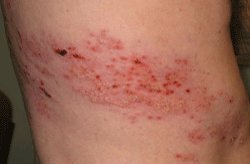 zoster_male1 wheatgrass stops shingles pain
