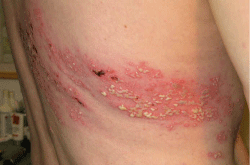 zoster_male21 herpes zoster pre wheatgrass treatment