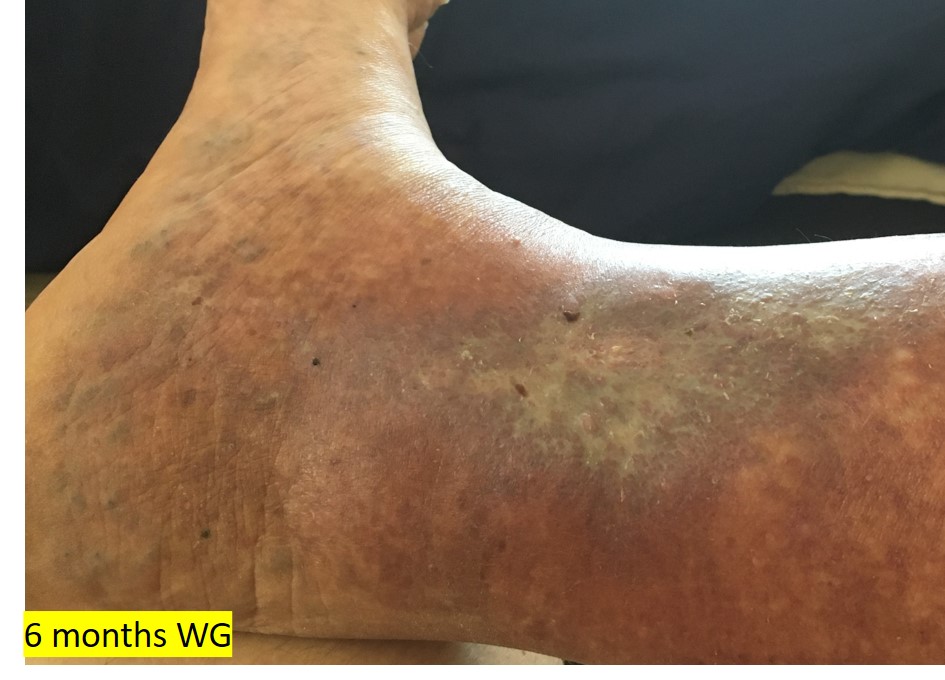 6months WG - healed 6months WG - healed