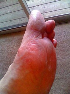 Aug15BigToe_tpj-225x300 Fungal infection. 7 years.