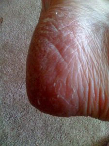 Aug15Heel-tpj-225x300 Heel of same patient.