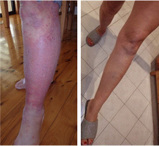 <strong>Fig. 5.</strong> Wheatgrass can sometimes achieve rapid improvement. This female TSW patient had suffered gross swelling to both legs for several years. She had applied wheatgrass extract for several months with no reduction in swelling. Her daughter then decided to stop applying the many creams, moisturisers etc. she had been applying and only used wheatgrass. Within a few days, there was a dramatic reduction in swelling as can be seen in the photos. (View report from daughter)