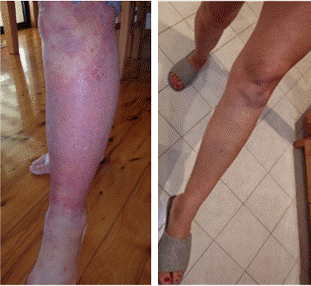 LEG EDEMA REDUCED COMP <strong>Fig. 5.</strong> Wheatgrass can sometimes achieve rapid improvement. This female TSW patient had suffered gross swelling to both legs for several years. She had applied wheatgrass extract for several months with no reduction in swelling. Her daughter then decided to stop applying the many creams, moisturisers etc. she had been applying and only used wheatgrass. Within a few days, there was a dramatic reduction in swelling as can be seen in the photos. (View report from daughter)