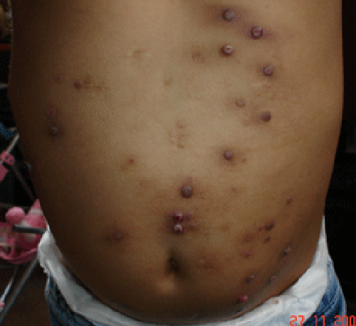 Large, inflamed molluscum spots, some pus-filled. due to cantharone.