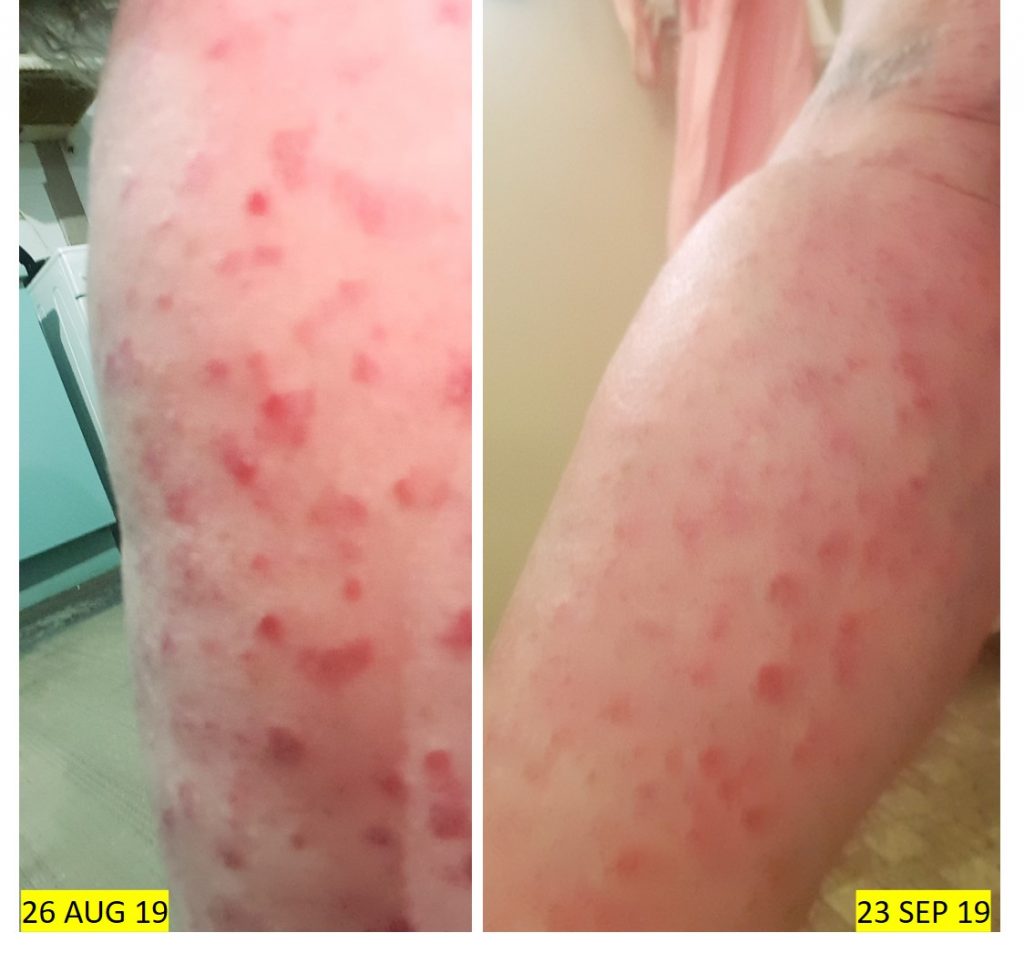 M.-C.-PSORIASIS-4-WKS-WG-1-1-1024x953