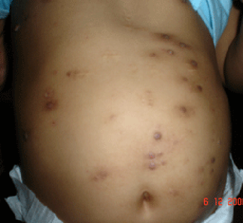 Mcontagiosum_abdo_postWG-e1525432815636 9 days later, lesions have flattened & some have almost disappeared. Notice there is less inflammation & pus is no longer present.