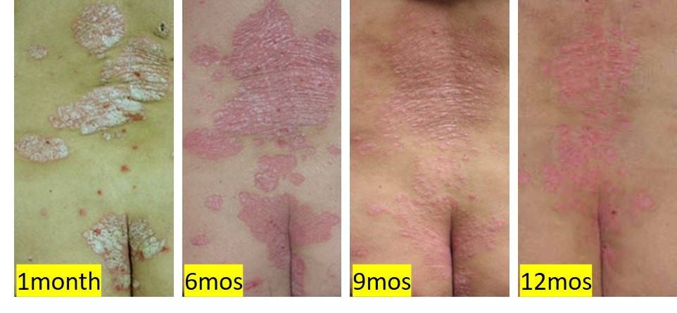 Psoriasis-1 Gradual but effective improvement of severe psoriasis due to wheatgrass treatment and perseverance by the patient.