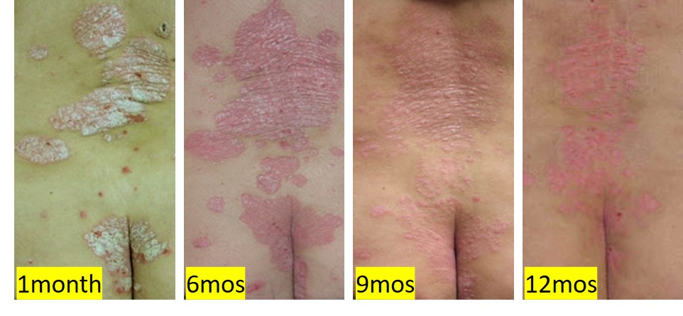 Gradual but effective improvement of severe psoriasis due to wheatgrass treatment and perseverance by the patient.