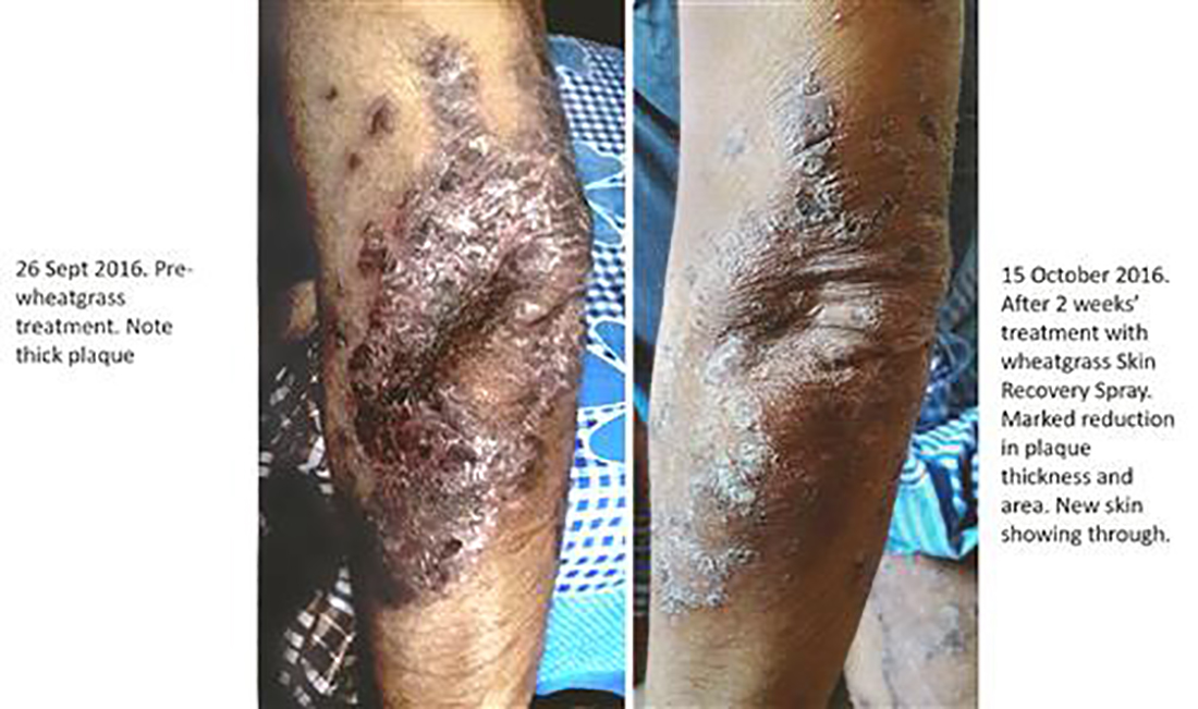 Psoriasis.-Elbow.-Rapid-removal-of-plaque-3_New Dramatic reduction in psoriatic plaque in 2 weeks.