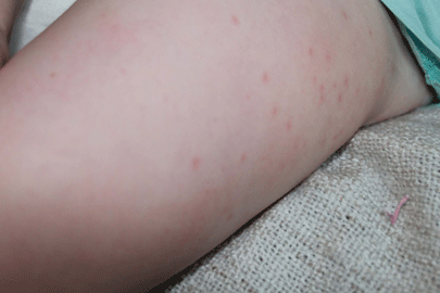RR_AfterLeg Upper leg after 4 weeks wheatgrass extract treatment. Note marked improvement.