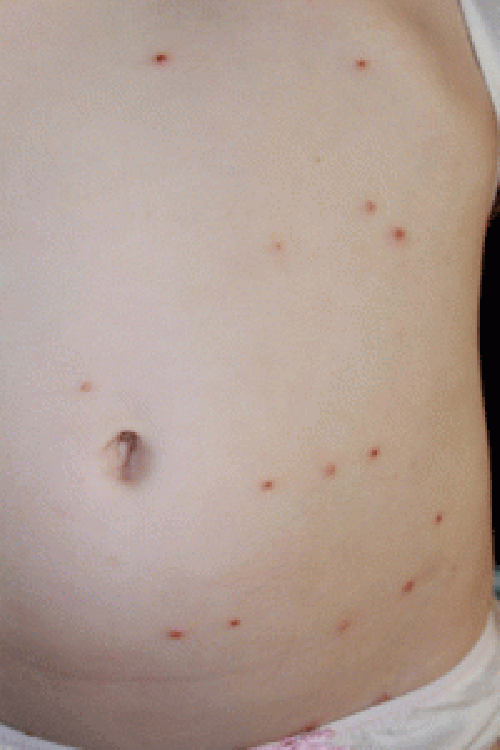 Molluscum contagiosum pre-wheatgrass extract.