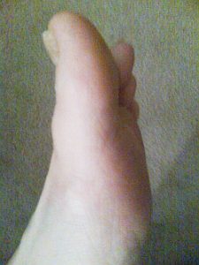 Sept1stBigToe_TPJ-225x300 After 2 weeks' application of daily wheatgrass extract, the fungus has been eliminated.