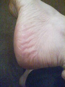 Sept1stHeel1-tpj-225x300 Tinea pedis fungus eliminated.