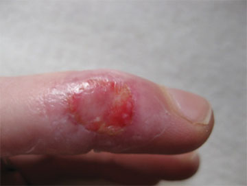Fig. 2. Just 16 hours after the patient applied wheatgrass extract to the wound, it has already been debrided (loose skin removed etc.), and blood circulation restored.