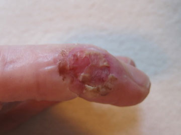 Skin-graft-LC_1jun11 skin carcinoma heals quickly with wheatgrass extract