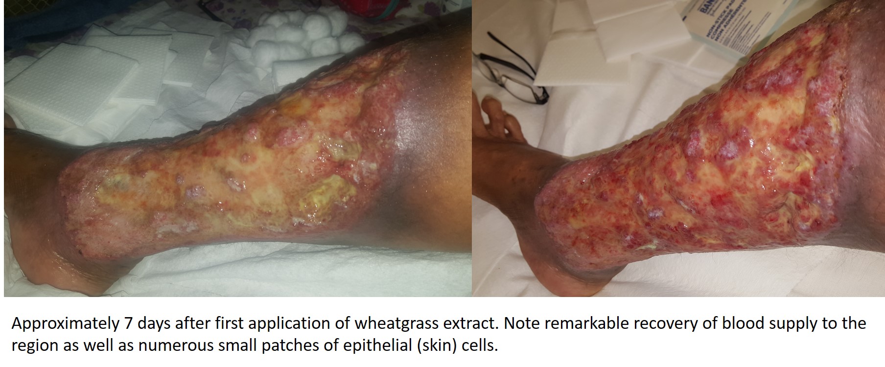 WG extract induces restoration of blood supply to leg ulcer Leg ulcer recovery