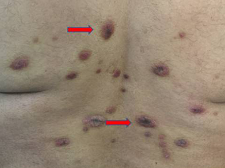 psoriasis back after Fig. 5. 2 months after wheatgrass extract application.