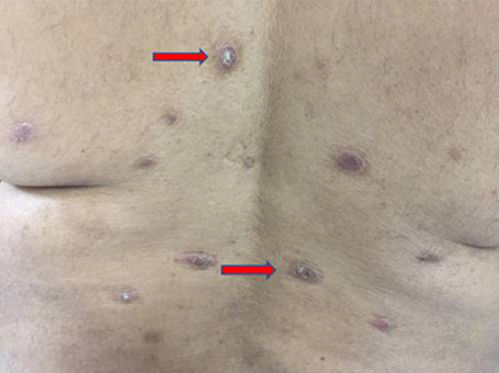 Fig. 4. Chronic psoriasis prior to wheatgrass extract.