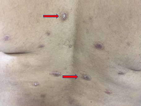 psoriasis back before Fig. 4. Chronic psoriasis prior to wheatgrass extract.