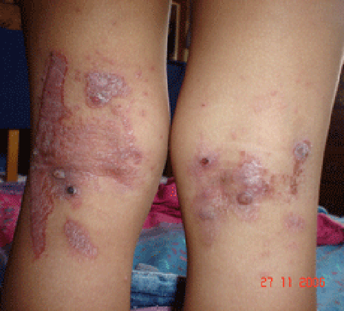 Painful burns in a 2 year old child one day after treatment with Cantharone for molluscum spots which are clearly visible.