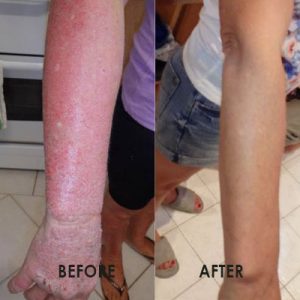 eczema-arm eczema-arm