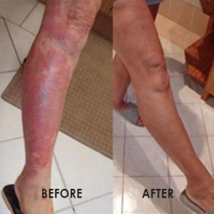 eczema-leg eczema-leg