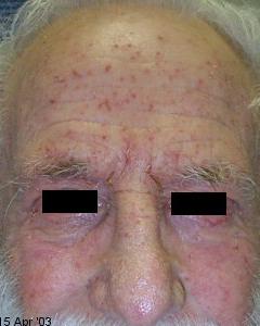 eczema_flare (2) eczema_flare (2)