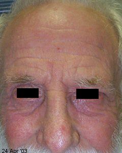 eczema_flare (3) eczema_flare (3)
