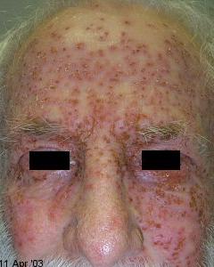 eczema_flare(1) eczema_flare(1)