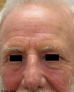 eczema_flare(4) eczema_flare(4)