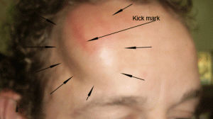 hematoma_front_1
Fig. 2. A large hematoma formed rapidly after a hefty kick from a player's boot. I ran on to the field and applied wheatgrass extract to his injury, and at the end of the game, there had been significant reduction of the player's bruise.