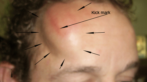 Fig. 2. A large hematoma forms rapidly after a hefty kick from a football boot. Wheatgrass extract was applied immediately. (I ran out on the field to do so.)