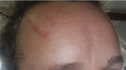 Rapid recovery of large bruise Fig. 2. 12 hours after application, the large swelling (hematoma) had disappeared, and he returned immediately to regular training.